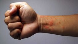 با این علائم اگزمای شدید آشنا شوید
