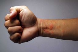 با این علائم اگزمای شدید آشنا شوید
