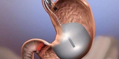 جراحی کاهش وزن از ریسک بیماری قلبی می کاهد