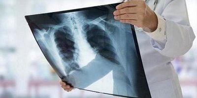 امکان پیشگیری از ۶۰ درصد کم‌شنوایی‌ها / از سکته گوش چه می‌دانیم؟
