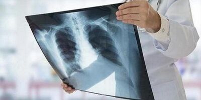 اولین قاتل بیماری‌های عفونی جهان را بشناسید
