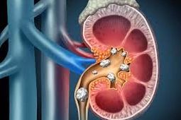 سنگ کلیه و علت تشکیل آن چیست ؟
