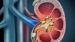 سنگ کلیه و علت تشکیل آن چیست ؟