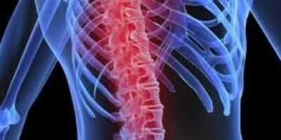 تحریک طناب نخاعی در کاهش نوروپاتی دیابتی موثر است