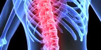 تحریک طناب نخاعی در کاهش نوروپاتی دیابتی موثر است