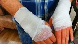 آیا خمیردندان و سیب زمینی برای سوختگی مفید است
