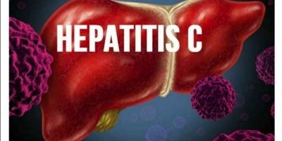 همه چیز درباره بیماری هپاتیت C