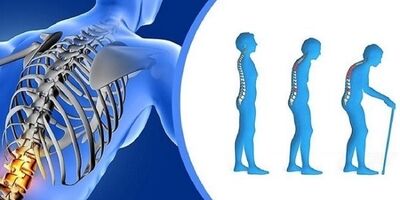 پوکی استخوان، بیماری خاموش و خطرناک اما قابل پیشگیری