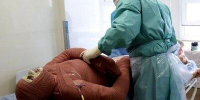 میزان سوختگی در ایران8 برابر میانگین جهانی است
