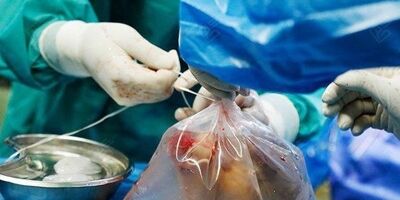 توزیع داروی بیماران پیوندی در تمام کشور