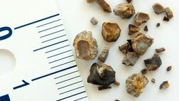 همه چیز راجع به سنگ مثانه که خوب است بدانید
