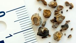 همه چیز راجع به سنگ مثانه که خوب است بدانید
